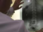 Escoliose e gravidez: as dificuldades da anestesia peridural no parto Paulo Franken/Agencia RBS