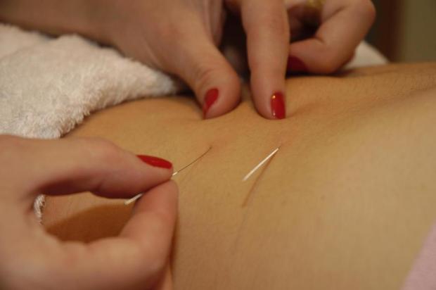 Acupuntura é especialidade médica, não terapia alternativa Jefferson Botega/Agencia RBS Acupuntura é especialidade médica, não terapia alternativa Jefferson Botega/Agencia RBS