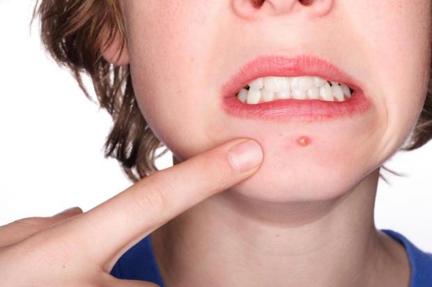 Objetos do dia a dia podem causar acne Stock Photos/Divulgação Objetos do dia a dia podem causar acne Stock Photos/Divulgação