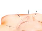 Tire todas as suas dúvidas na escolha de um bom profissional acupunturista AN, divulgação/ Tire todas as suas dúvidas na escolha de um bom profissional acupunturista AN, divulgação/