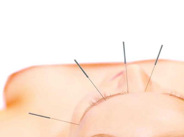 Tire todas as suas dúvidas na escolha de um bom profissional acupunturista AN, divulgação/ Tire todas as suas dúvidas na escolha de um bom profissional acupunturista AN, divulgação/