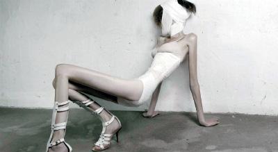 Anorexia: 20% dos casos terminam em morte  Ivonne Thein, Reprodução/