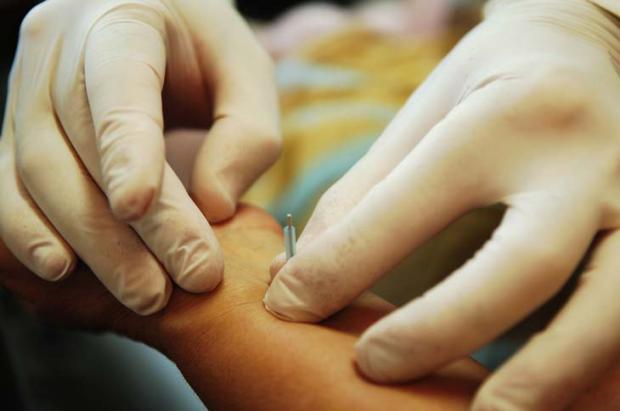 Novos estudos recomendam os benefícios da acupuntura em diversas áreas Daniel Marenco/ Novos estudos recomendam os benefícios da acupuntura em diversas áreas Daniel Marenco/